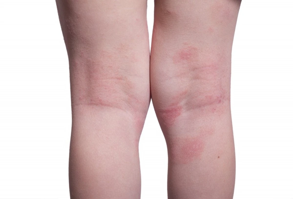 Donttellmum - Eczeem Repair Creme - 50 Ml 7 Donttellmum - Eczeem Repair Creme - 50 Ml - Afbeelding 5